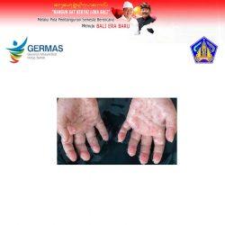 penyakit cacar monyet